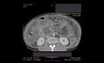 Abdominelle kontrastverstärkte Computertomographie bei Patienten mit Pankreasnekrose mit umgebender Wand 