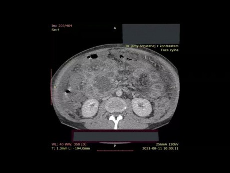 Abdominelle kontrastverstärkte Computertomographie bei Patienten mit Pankreasnekrose mit umgebender Wand 