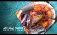 Minimal-invasiver Aortenklappenersatz - schwergradige Aortenklappeninsuffizienz