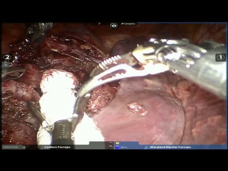 Zystischer Mediastinaltumor