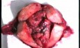 Totale laparoskopische Hysterektomie bei dem Endometriumkarzinom