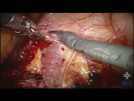Roboterassistierte Ureterreimplatation