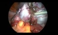 Endometriose-Operation (Laparoskopie)