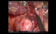Robotische D2-Gastrektomie – vollständiges Operationsverfahren