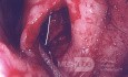 Leeres Nasensyndrom - Seitenwandimplantat