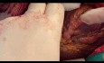 Patient mit riesigem Tumor im linken Vorhof und im linken Ventrikel, möglicherweise Hämangiom-Sarkom, nach Resektion und koronarer Rekonstruktion mit SVG