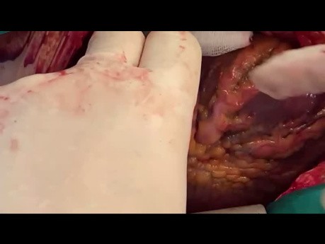 Patient mit riesigem Tumor im linken Vorhof und im linken Ventrikel, möglicherweise Hämangiom-Sarkom, nach Resektion und koronarer Rekonstruktion mit SVG