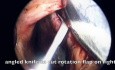 Reparatur einer Nasenseptumperforation