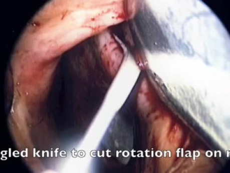 Reparatur einer Nasenseptumperforation