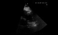 EKG und Echokardiografie - LV-Wandbewegungsstörungen