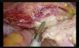 Totale Laparoskopische Hysterektomie im vorherigen Kaiserschnitt, dicht haftende Blase, saubere Dissektion