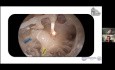 Anatomie des runden Fensters und endoskopisch unterstütztes Cochlea-Implantat