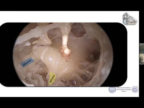 Anatomie des runden Fensters und endoskopisch unterstütztes Cochlea-Implantat