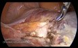 Totale laparoskopische Hysterektomie ESGE-Leitlinie