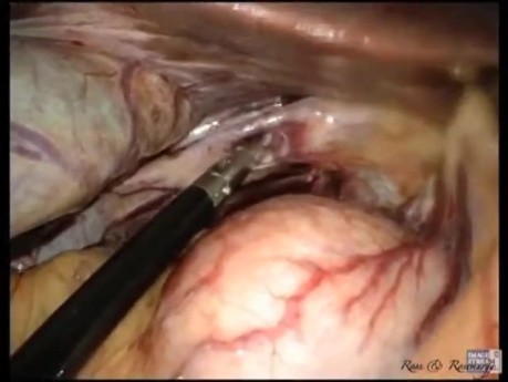 Die Entwicklung der laparoskopische Einzelzugangchirurgie-Cholezystektomie ohne Vollnarkose