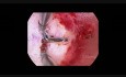 Uterus subseptus, unvollständige Septierung