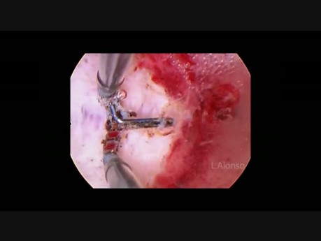 Uterus subseptus, unvollständige Septierung