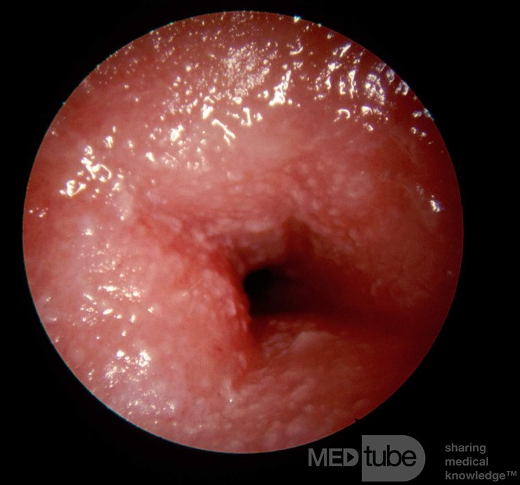 Akute allergische Kontaktekzem des äußeren Gehörgangs