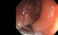 Endoskopische Polypektomie eines gigantischen Polypen – Colon descendens
