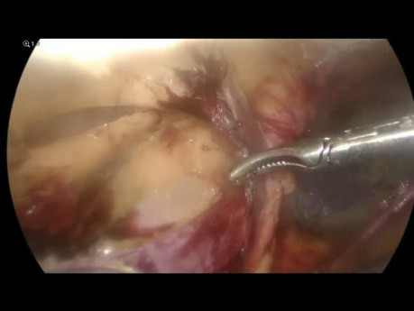 Leistenbruchchirurgie