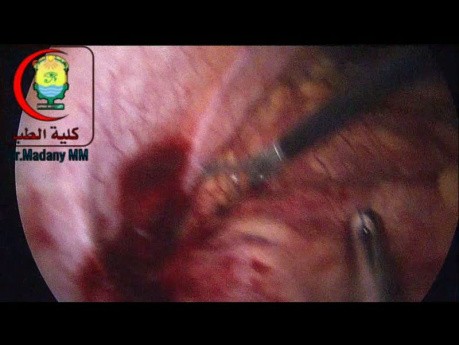 Appendix - ein klinischer Fall