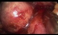 Retroperitoneoskopische partielle Nephrektomie