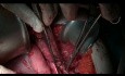 Supramesokolisches chirurgisches Management von Pseudomyxoma Peritonei
