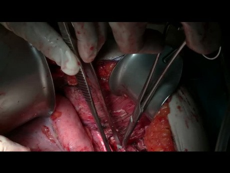 Supramesokolisches chirurgisches Management von Pseudomyxoma Peritonei