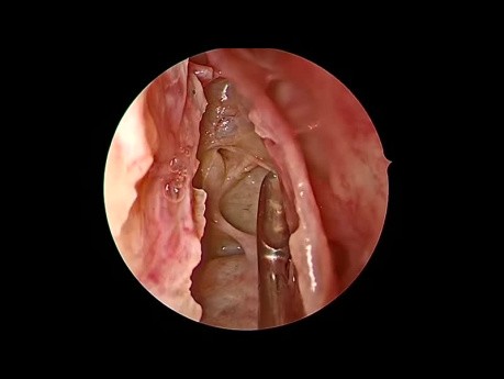 Endoskopische Nasennebenhöhlenchirurgie: Anteriore Ethmoidektomie – Dissektionsschritte