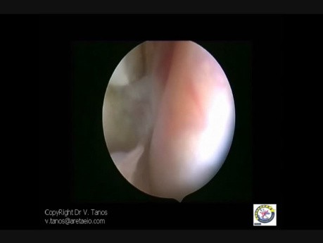 Endometriose- die totale vaginale Länge (tvl)