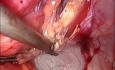 Hernienchirurgie nach der IPOM-Methode mit Hernioplastik