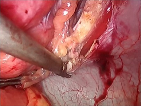 Hernienchirurgie nach der IPOM-Methode mit Hernioplastik