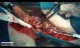 Fundektomie des Uterus