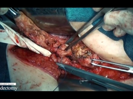 Fundektomie des Uterus