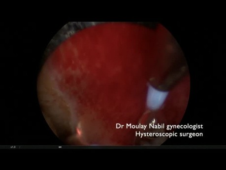 Entfernung des Polyps und Ablation von Endometrioseherden