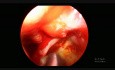 Synechien nach Strahlentherapie bei einem undifferenzierten Nasopharynxkarzinom