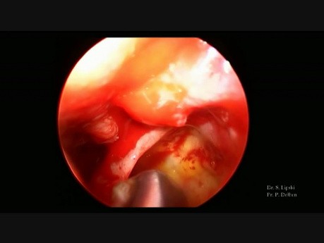 Synechien nach Strahlentherapie bei einem undifferenzierten Nasopharynxkarzinom