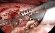 Zystogastrostomie - Pankreas-Pseudozysten