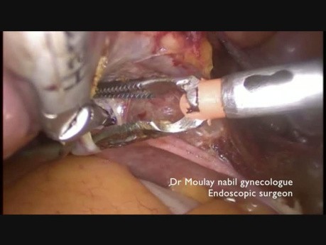 Totale laparoskopische Hysterektomie für Anfänger.