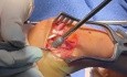 Intraoperative Strategieänderung bei rheumatoider Arthritis: PIP-Arthrodese statt Arthroplastik