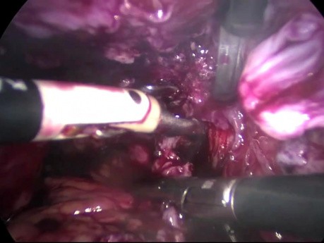 Operative Behandlung von schwerer Endometriose- totale laparoskopische Hysterektomie
