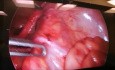 Laparoskopie bei strangulierter Darmschlinge im breiten Ligamentum uteri
