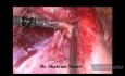 Laparoskopie bei akuter eitriger Appendizitis