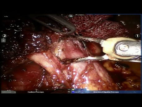 Bronchialkarzinom im Mittellappen - roboterassistierte Chirurgie