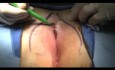 Bascom II Pilonidalzystenoperation (Langversion)