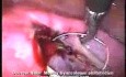 Proximale Salpingoplastik laparoskopisch mittels Stenting-Technik