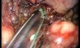 Laparo-endoskopische Single Site (LESS) distale Pankreatektomie und Splenektomie