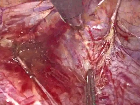 Laparoskopisches Nähen des Gebärmutterhalses mit Mersilene-Naht