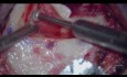 Kombinierter Ansatz der Cholesteatomchirurgie (endoskopisch und mikroskopisch)