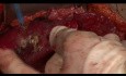 Chirurgische Aspekte von Pseudomyxoma Peritonei